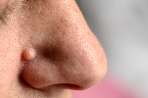 Tratamiento de verrugas con crioterapia