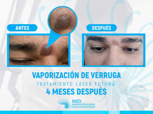cicatriz eliminación de verrugas