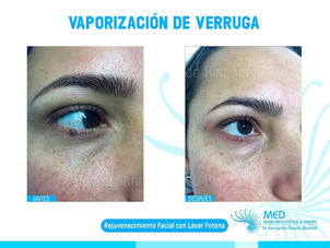 antes y después de eliminación de verrugas