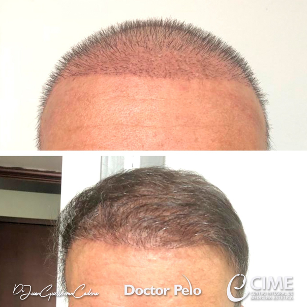 antes y después de implante de cabello