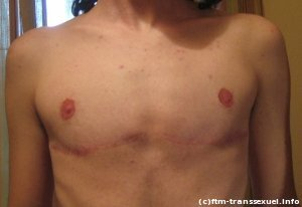 Mastectomía bilateral FTM