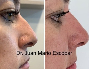 rinomodelacion antes y después