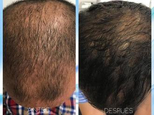 Tratamiento alopecia