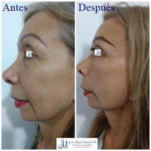 Rejuvenecimiento facial