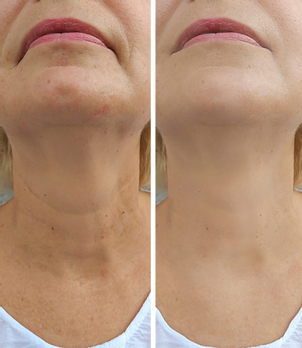 Cuello de mujer antes y después del Nanofat