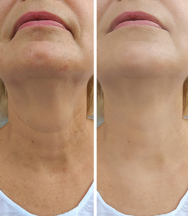 Cuello de mujer antes y después del Nanofat
