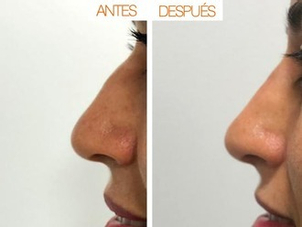 rinomodelacion antes y después