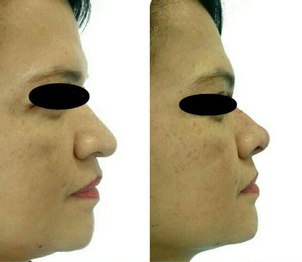 ¿Qué son los hilos tensores?