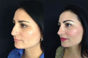 Resultados rinoplastia