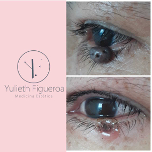 Resultados eliminación de verrugas