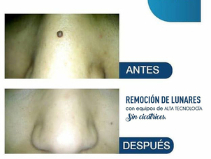 antes y después de eliminar verrugas