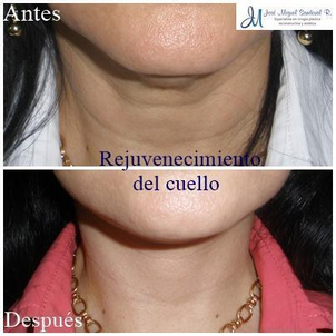 rejuvenecimiento facial