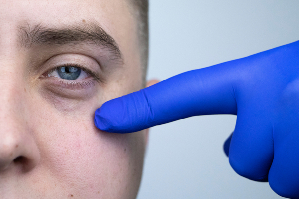 Dedo de un médico señalando el rostro de un hombre con ojeras