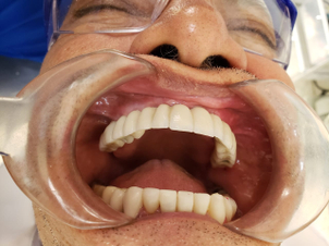 antes y después implantes dentales