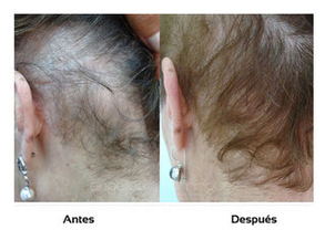 Antes y después alopecia