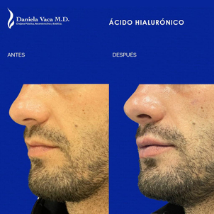 Antes y después aumento labios