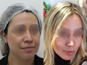 Postoperatorio de una bichetomía