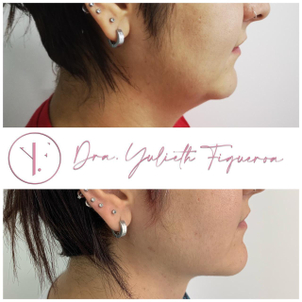 Antes y después de un hombre con cirugía de papada