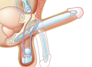 prótesis eréctil FTM