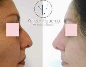 rinomodelacion antes y después