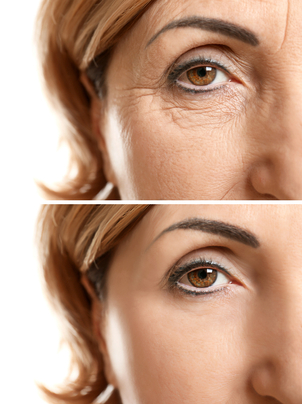 recuperación tratamiento antiojeras