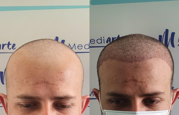 antes y después de implante de cabello