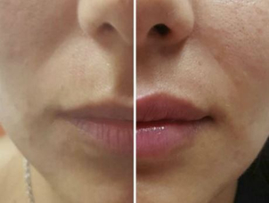 Antes y después aumento labios