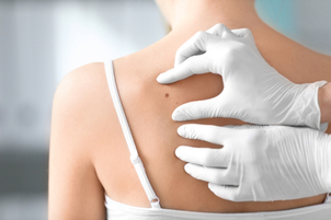 Revisión de lunares