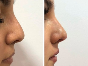 rinomodelacion antes y después