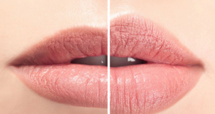 Liplift para aumento de labios