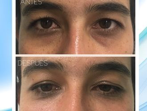 antes y después ojeras