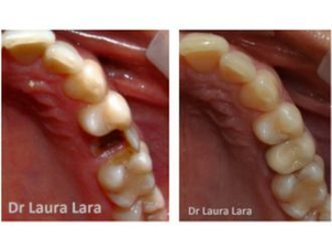 antes y después implantes dentales