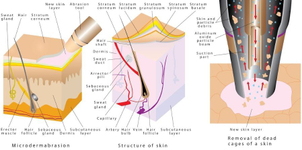 La microdermoabrasión