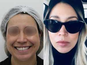 antes y después bolsas bichat