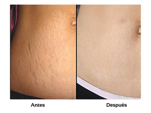 Antes y después de eliminar estrías