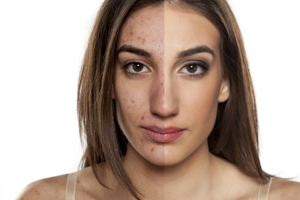 Quien puede sufrir acné
