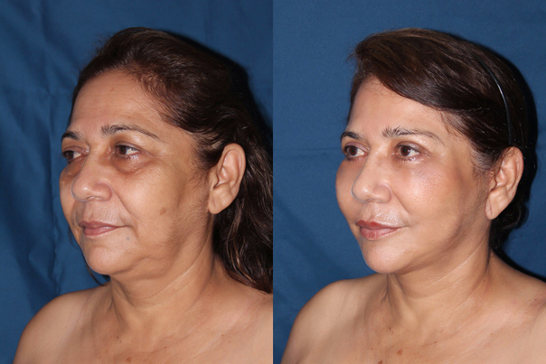 Antes y después de lifting facial