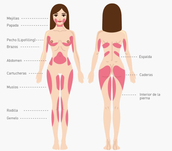 Zonas del cuerpo para liposucción