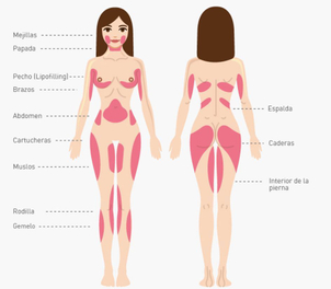 Zonas del cuerpo para liposucción