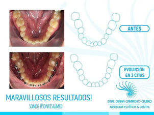 antes y después de ortodoncia