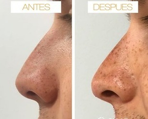 rinomodelacion antes y después