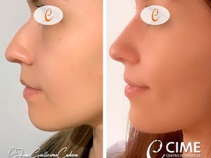 rinomodelacion antes y después