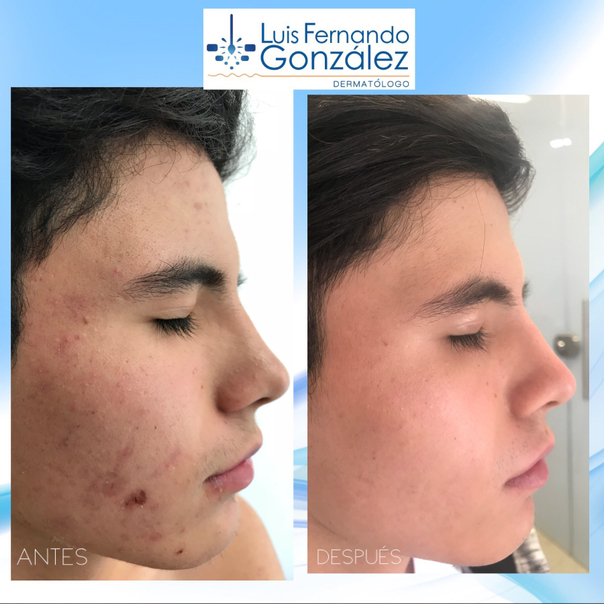 Antes y después de tratamiento acné