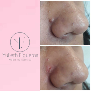 antes y después de eliminación de verrugas