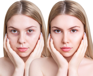 Postoperatorio de bolsas en los ojos