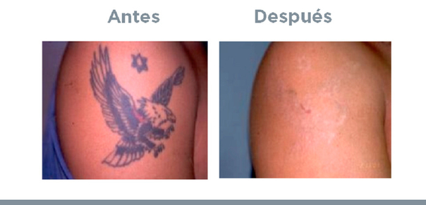 Antes y después de borrar tatuaje