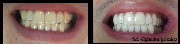 antes y después blanqueamiento dental
