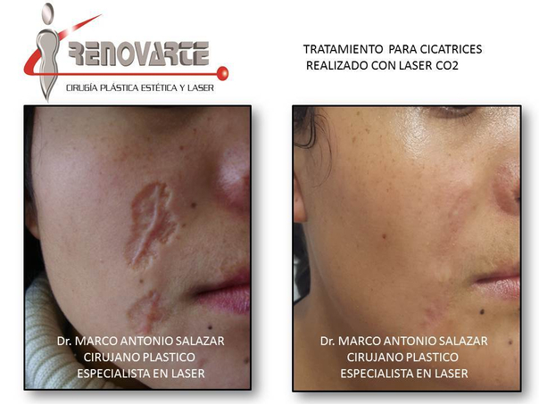 Antes y después de el tratamiento de cicatriz