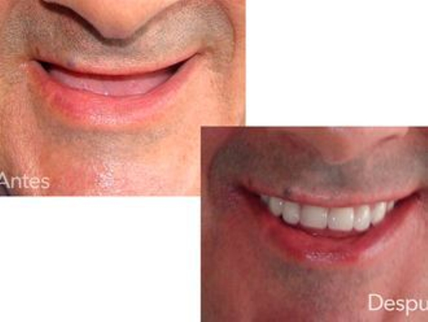 antes y después implantes dentales