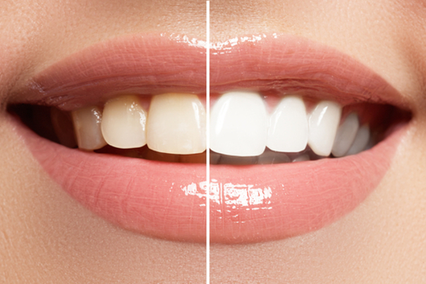 antes y después blanqueamiento dental